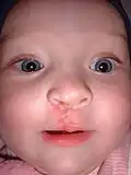 The same girl, one month after the surgery