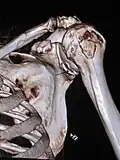 3-D CT reconstruction of a bankart lesion which occurred post anterior shoulder dislocation. This subject's humerus remains mildly superiorly subluxated. Fracture marked by a black arrow.
