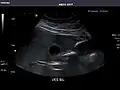 Gallbladder