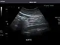 Aorta