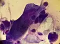 Acantholytic cell and multinucleated giant cell on a smear taken from a vesicular lesion of herpes simplex infection (May-Grünwald Giemsa x1000).