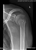 Radiograph showing a bony Bankart lesion with stationary fragment at the inferior glenoid