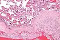 Micrograph of chronic deciduitis. H&E stain.