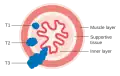 T1, T2, and T3 stages of esophageal cancer