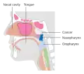 Stage T2 nasopharyngeal cancer