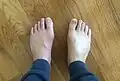 Gout in the big toe of the left foot, compared to the healthy right foot