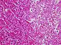 Cytoplasmic hypereosinophilia (seen in left half of image)