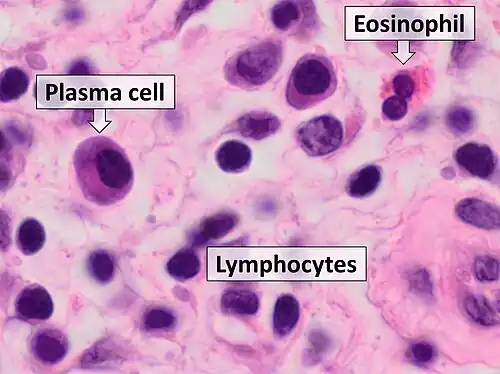 Benign chronic mixed inflammation of an inflammatory sinonasal polyp