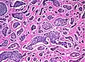 Carcinoid