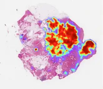 Breast cancer prediction by AI.[17]
