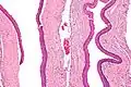 Intermediate magnification of an odontogenic keratocyst showing a folded cyst.