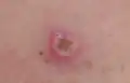 Melanoma, right posterior thigh