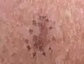 Melanoma in situ, left anterior shoulder marked for biopsy