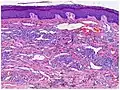 Micrograph of plaque stage, with bizarre vessels dissecting the upper dermis. There is erythrocyte extravasation and hemosiderin pigmentation.[16]