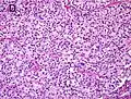 Gleason score 8 (4+4) with fused glands with cytoplasmic vacuoles