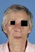 Moderate-sized anterior cheek defect final result