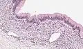Mucinous cystadenoma of the pancreas