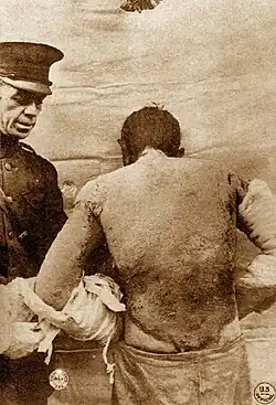 Soldier with severe mustard gas burns to back and arms, circa 1918. These burns are severe enough to be life-threatening.