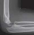 The radiocapitellar line is used in the detection of radial head dislocation on lateral X-rays. It normally goes through the capitulum of the humerus.[4]