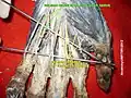 Palmar branch of ulnar nerve