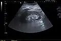 A very small (8&nbsp;mm) simple renal cyst.