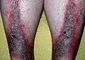 Stasis dermatitis (Gravitational eczema)