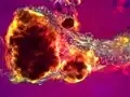 Tophus of uric acid crystals from toe joint fluid (100x polarized light)